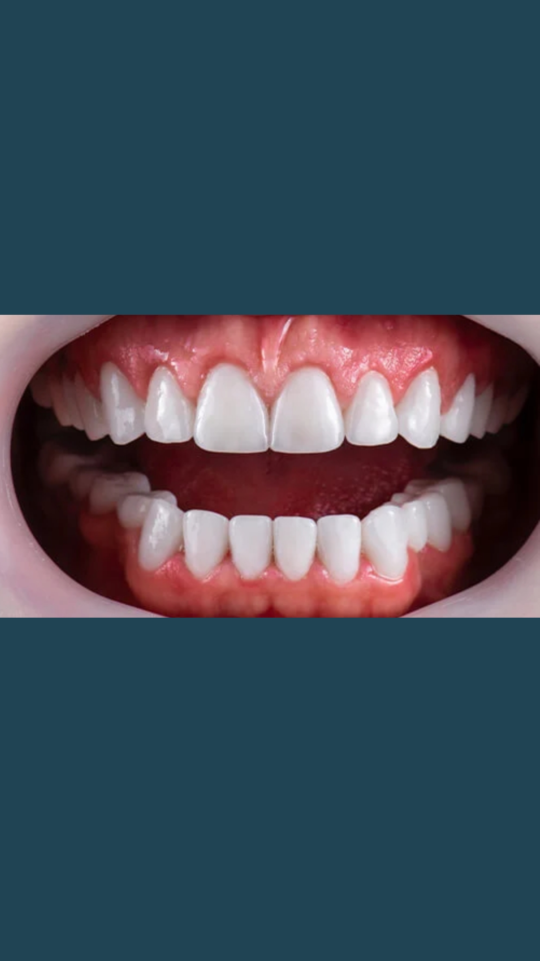 Dopo il trattamento - Faccette in ceramica